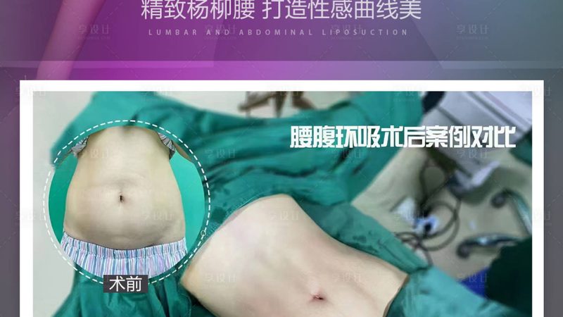 在进行硅胶隆鼻取出后的二次手术时，需要注意以下几点：