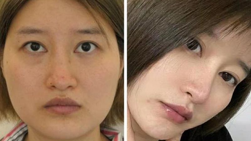成都肉毒素代理价格，揭秘背后的秘密