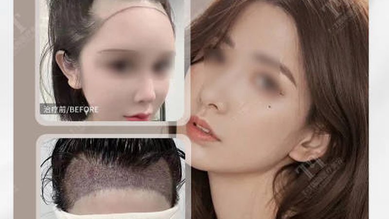 误区：水光针可以永久去除皱纹