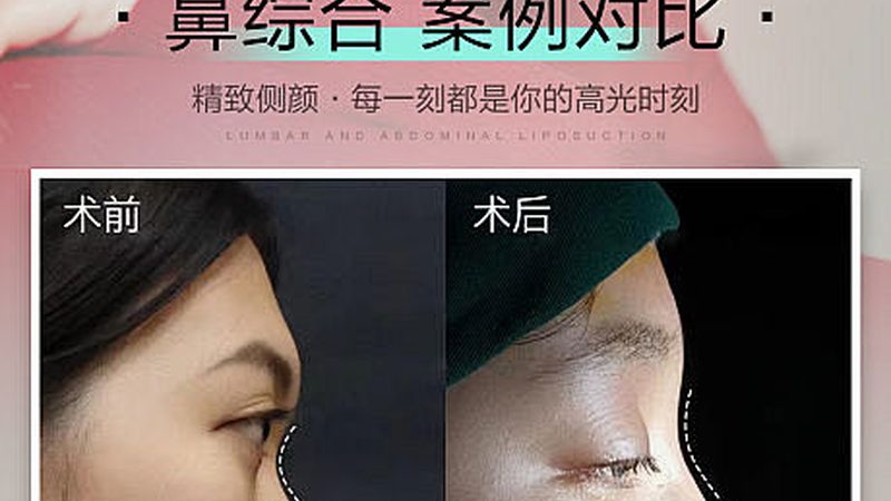光子嫩肤仪器，揭秘规格型号背后的秘密
