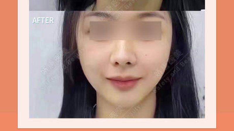 相较于传统手术，男士埋线提升具有以下优势：