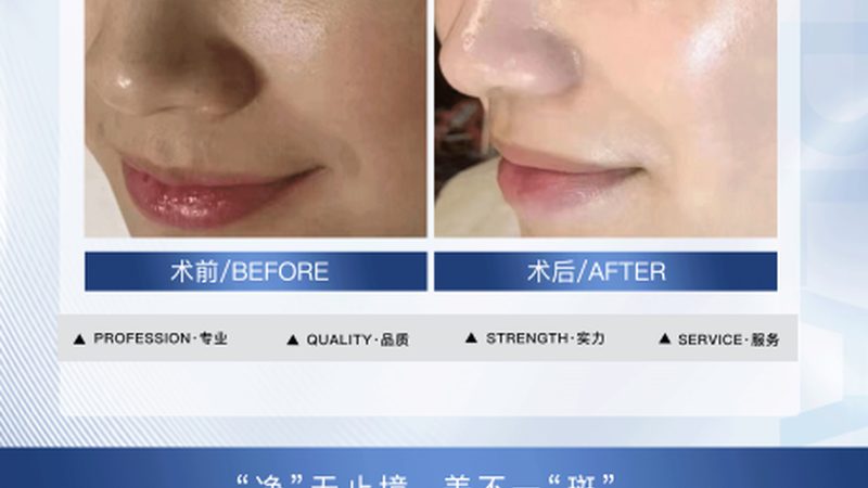 面部激光脱毛：揭秘步骤与注意事项**