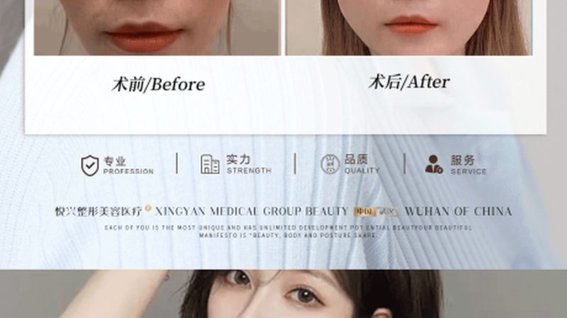 小标题：双眼皮手术，了解其本质