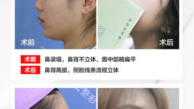 水光针注射后多久洗脸？揭秘恢复期的护理细节