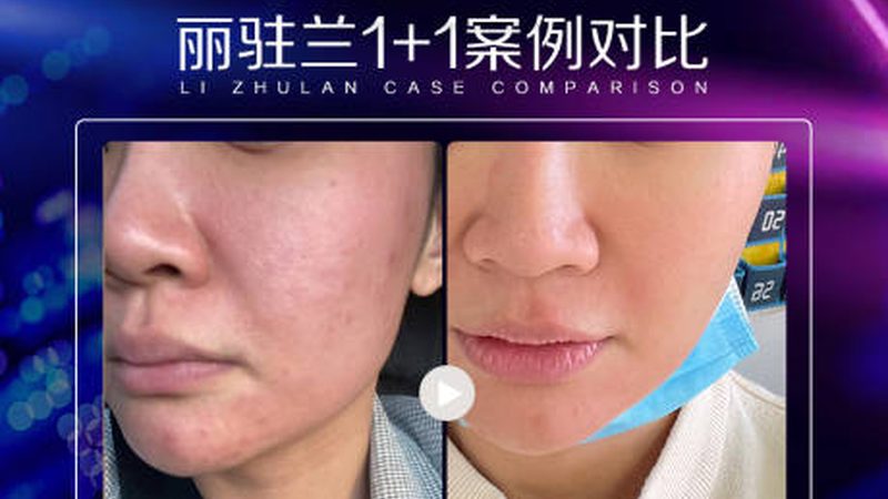 隆鼻与鼻唇角：揭秘面部协调之美